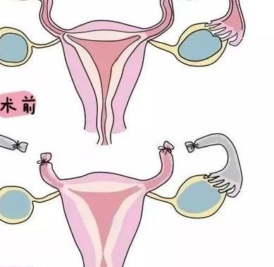 一代试管不对精子筛选精子异常无法做？